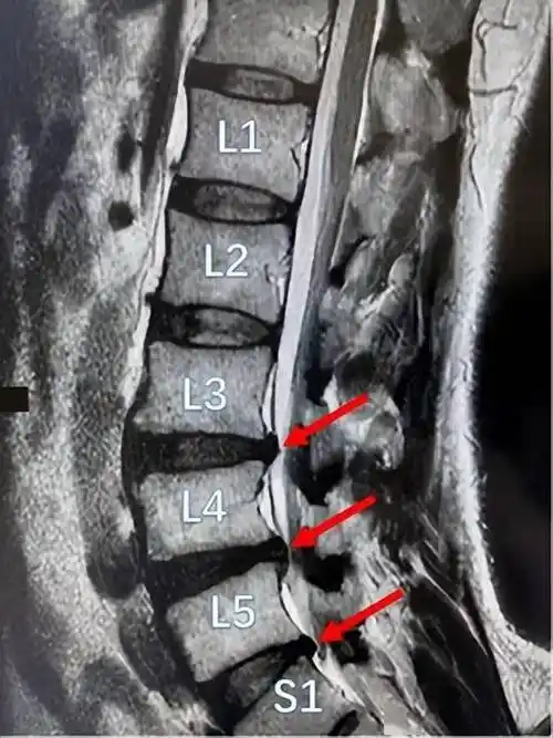 麻将桌上"鏖战"几小时,39岁男子双腿突然动不了_压迫_进行_腰椎间盘