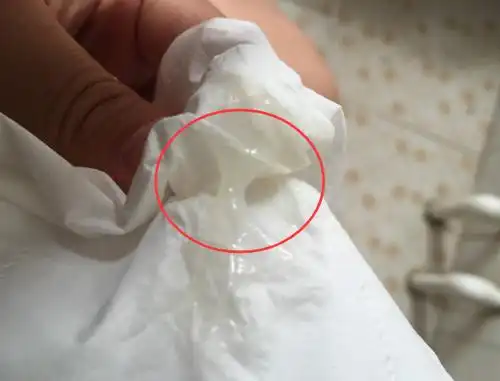 有这种尿液颜色变化的,也需要警惕是子宫有炎症了,一般是宫颈炎或者